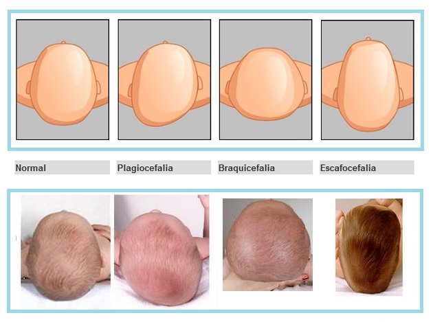 This image has an empty alt attribute; its file name is plagiocephaly-baby-2.jpg